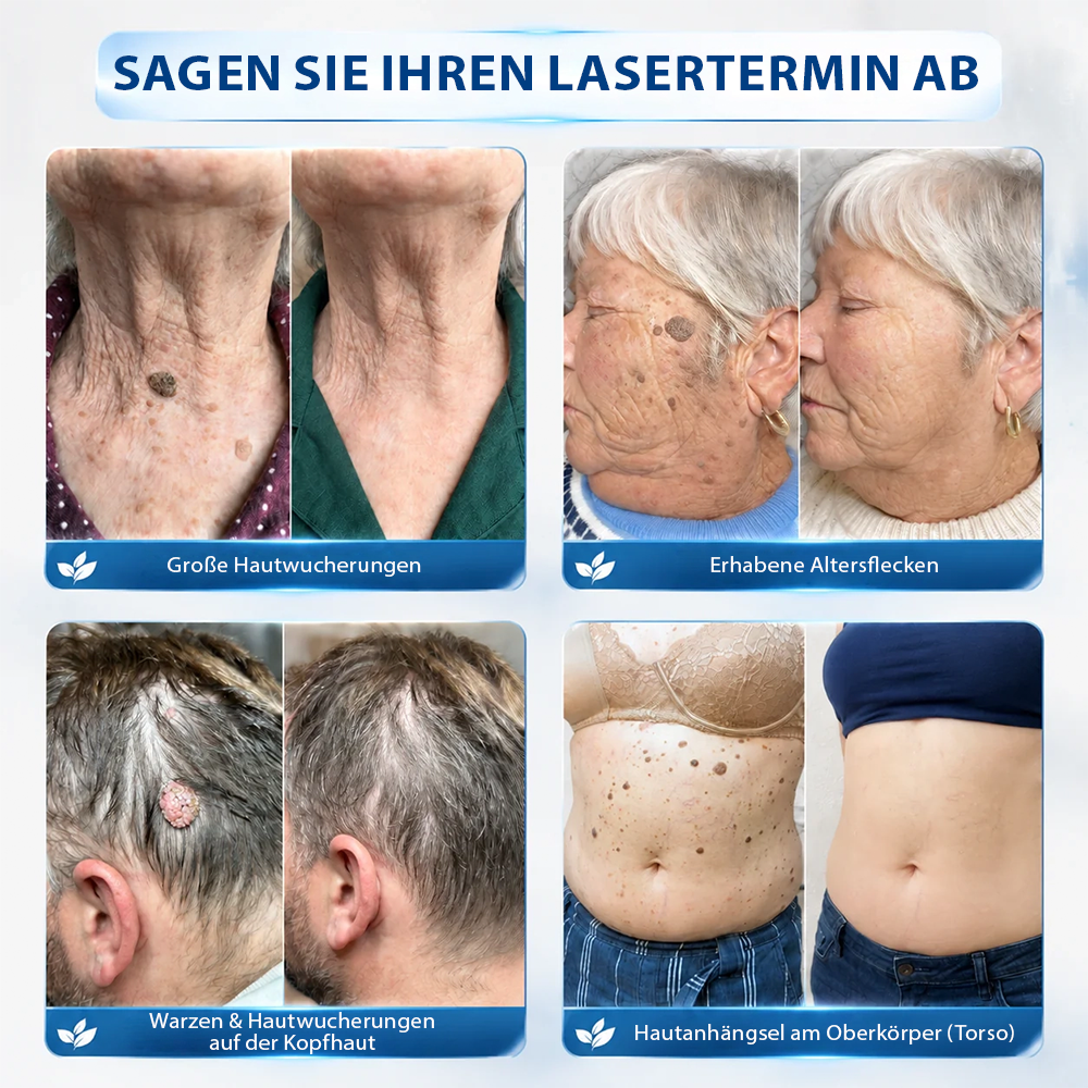 Hergestellt und versandt aus Deutschland ✨ Evolvion® 𝟕-Tage-Hautanhangs- & Pigmentflecken-Entferner – Schmerzfreie und narbenfreie fortschrittliche Lösung zur Beseitigung von Hautunreinheiten mit Roll-On-Pen ✨