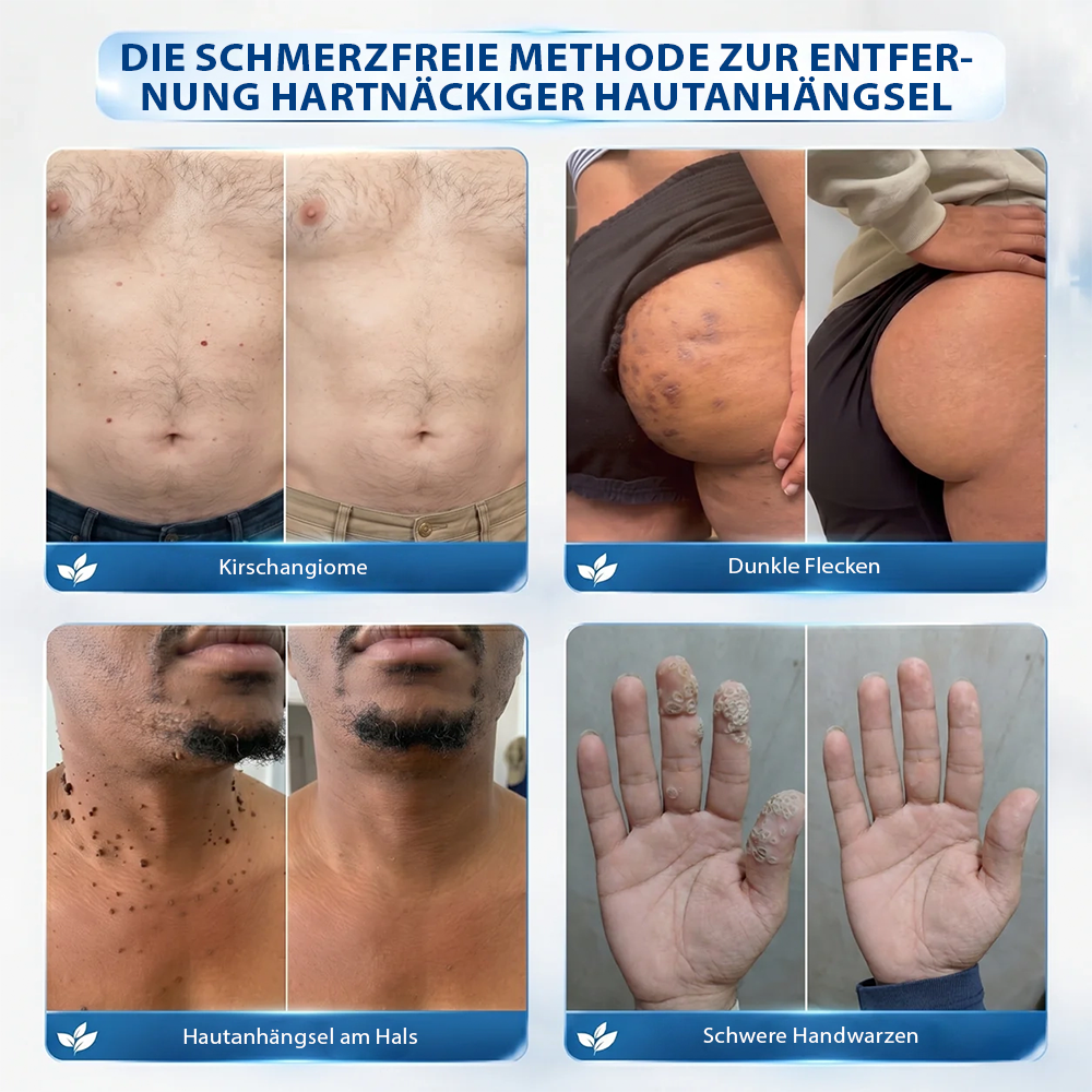 Hergestellt und versandt aus Deutschland ✨ Evolvion® 𝟕-Tage-Hautanhangs- & Pigmentflecken-Entferner – Schmerzfreie und narbenfreie fortschrittliche Lösung zur Beseitigung von Hautunreinheiten mit Roll-On-Pen ✨