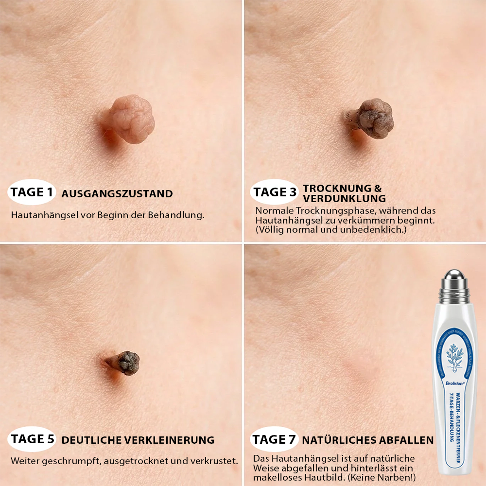 Hergestellt und versandt aus Deutschland ✨ Evolvion® 𝟕-Tage-Hautanhangs- & Pigmentflecken-Entferner – Schmerzfreie und narbenfreie fortschrittliche Lösung zur Beseitigung von Hautunreinheiten mit Roll-On-Pen ✨