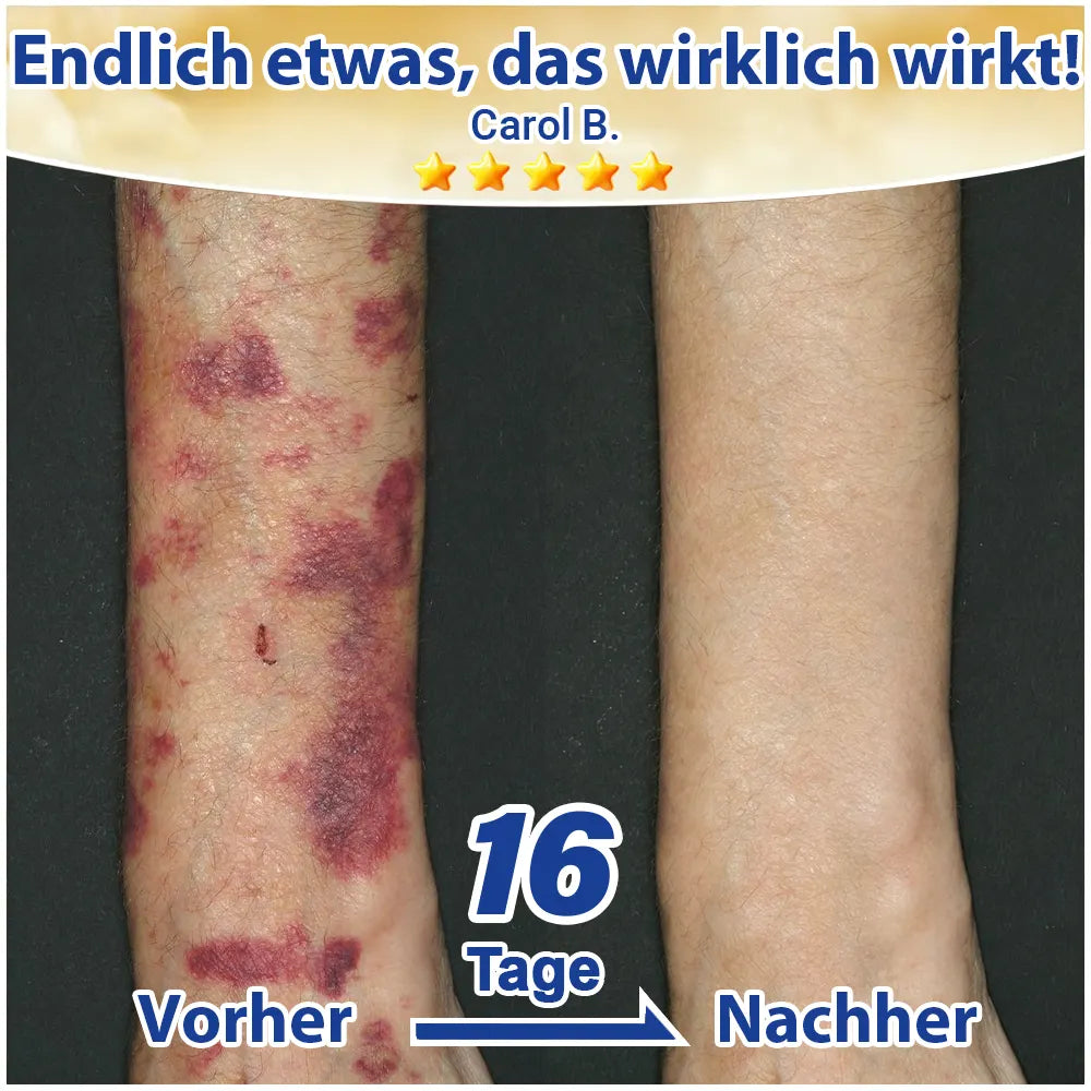 💛 Evolvion® Pflegecreme bei seniler Purpura, Blutergüssen & fragiler Haut🔥🔥