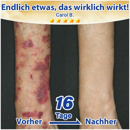 💛 Evolvion® Pflegecreme bei seniler Purpura, Blutergüssen & fragiler Haut🔥